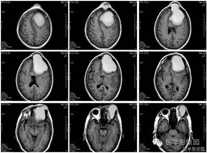 【病例】额窦巨大粘液囊肿1例MR影像表现 【病例】额窦巨大粘液囊肿1例MR影像表现