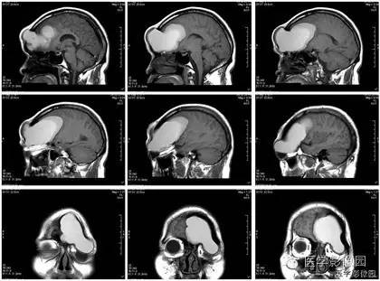 【病例】额窦巨大粘液囊肿1例MR影像表现 【病例】额窦巨大粘液囊肿1例MR影像表现