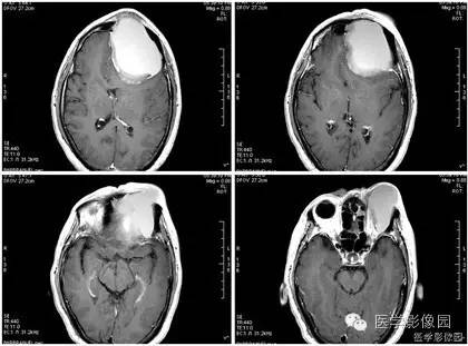 【病例】额窦巨大粘液囊肿1例MR影像表现 【病例】额窦巨大粘液囊肿1例MR影像表现
