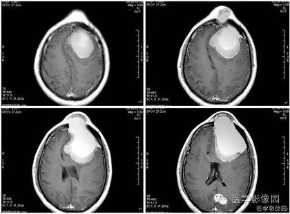 【病例】额窦巨大粘液囊肿1例MR影像表现 【病例】额窦巨大粘液囊肿1例MR影像表现