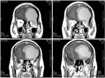 【病例】额窦巨大粘液囊肿1例MR影像表现 【病例】额窦巨大粘液囊肿1例MR影像表现