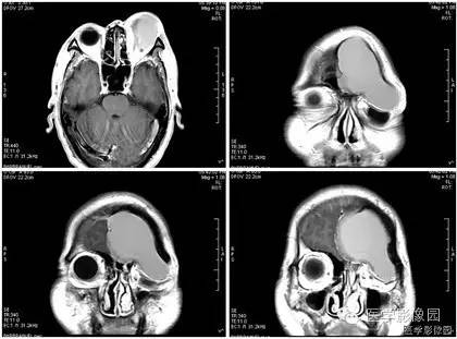 【病例】额窦巨大粘液囊肿1例MR影像表现 【病例】额窦巨大粘液囊肿1例MR影像表现