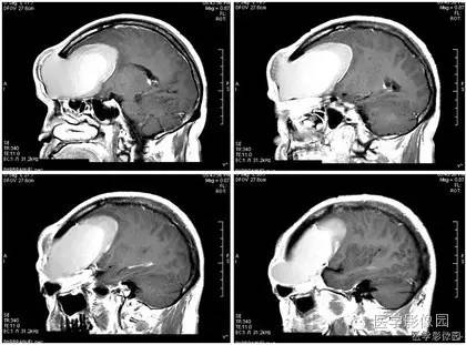 【病例】额窦巨大粘液囊肿1例MR影像表现 【病例】额窦巨大粘液囊肿1例MR影像表现