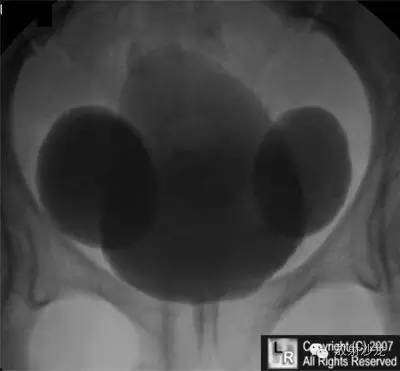 【病例】双侧巨大膀胱憩室1例X线影像表现