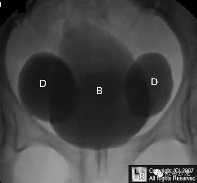 【病例】双侧巨大膀胱憩室1例X线影像表现 【病例】双侧巨大膀胱憩室1例X线影像表现