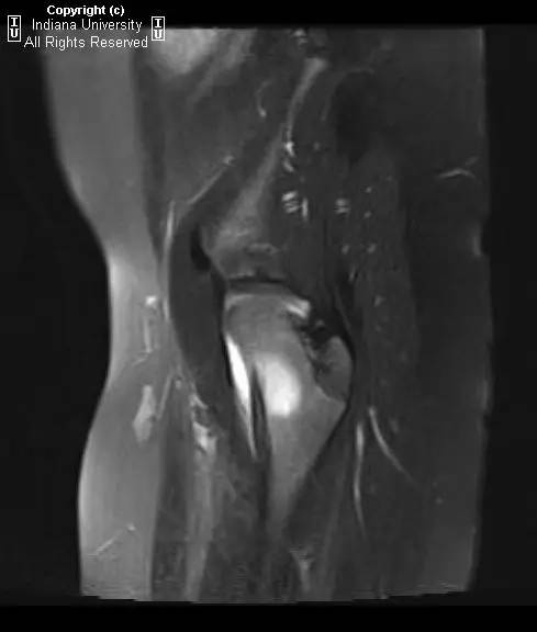 【病例】股骨颈骨样骨瘤1例CT及MR影像表现 【病例】股骨颈骨样骨瘤1例CT及MR影像表现