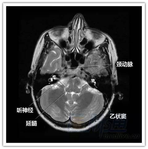 简明易懂的脑部断层解剖：横断位MRI