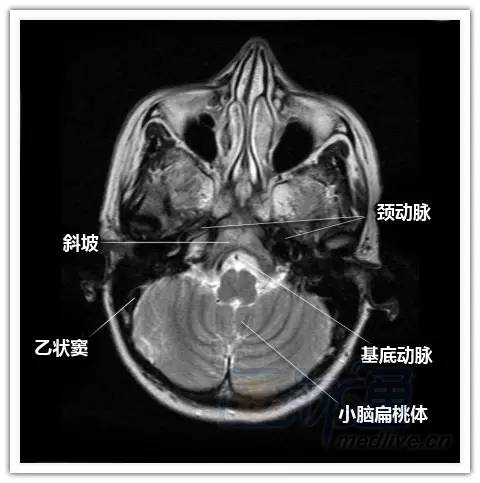 简明易懂的脑部断层解剖：横断位MRI