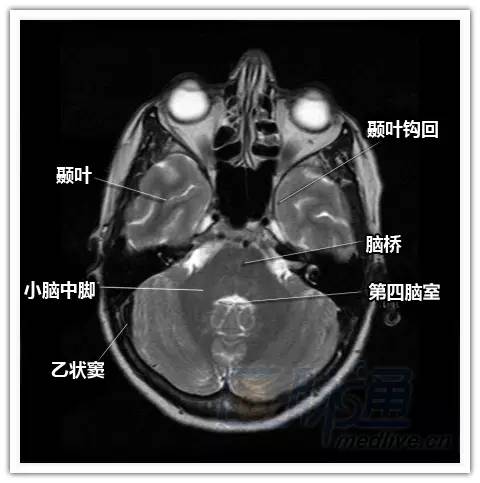 简明易懂的脑部断层解剖：横断位MRI