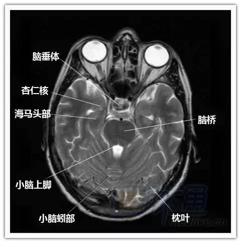 简明易懂的脑部断层解剖：横断位MRI