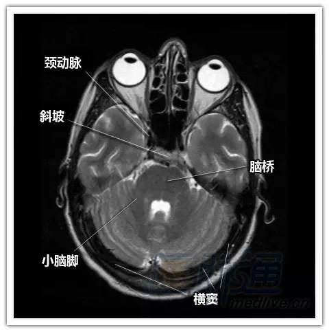 简明易懂的脑部断层解剖：横断位MRI