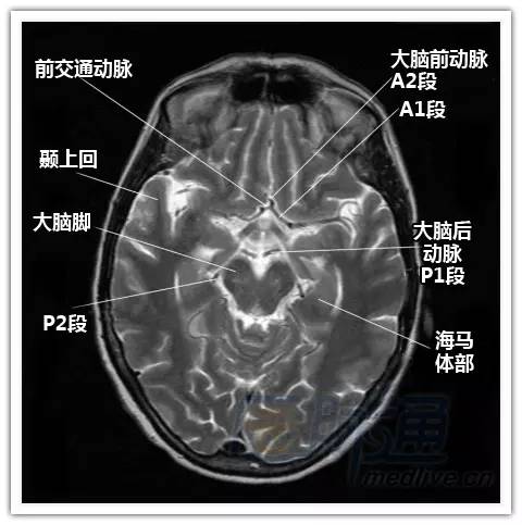简明易懂的脑部断层解剖：横断位MRI