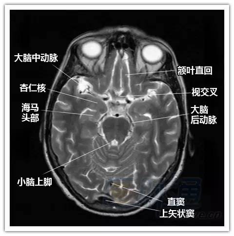 简明易懂的脑部断层解剖：横断位MRI