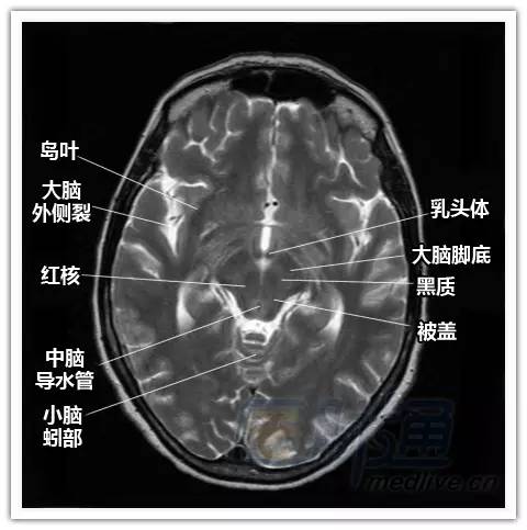 简明易懂的脑部断层解剖：横断位MRI
