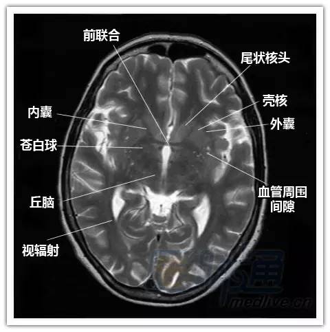 简明易懂的脑部断层解剖：横断位MRI