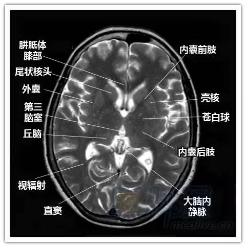 简明易懂的脑部断层解剖：横断位MRI