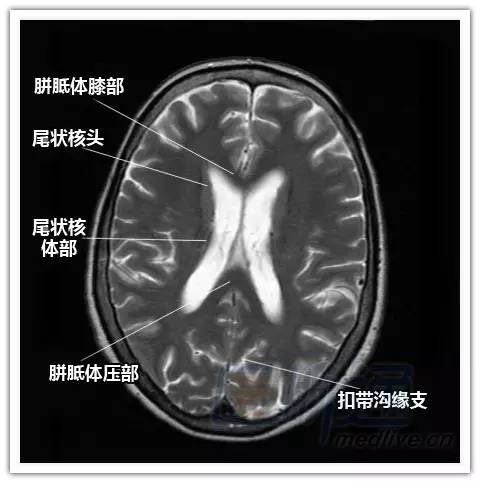 简明易懂的脑部断层解剖：横断位MRI