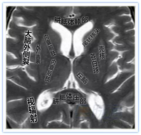 简明易懂的脑部断层解剖：横断位MRI