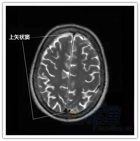 简明易懂的脑部断层解剖：横断位MRI