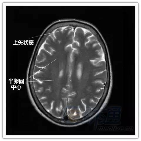 简明易懂的脑部断层解剖：横断位MRI