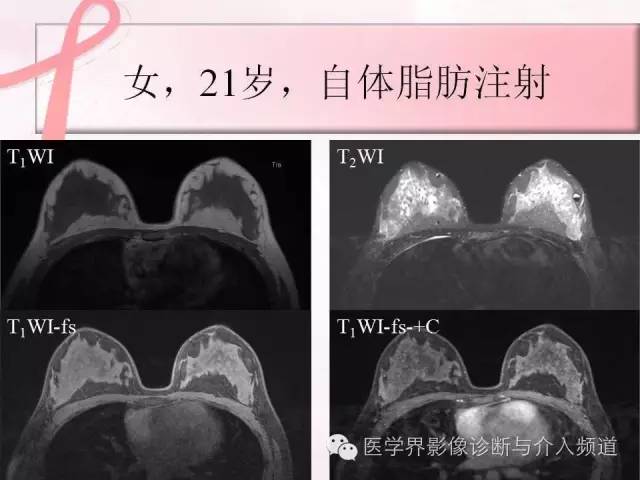 【PPT】隆乳术及其MRI表现