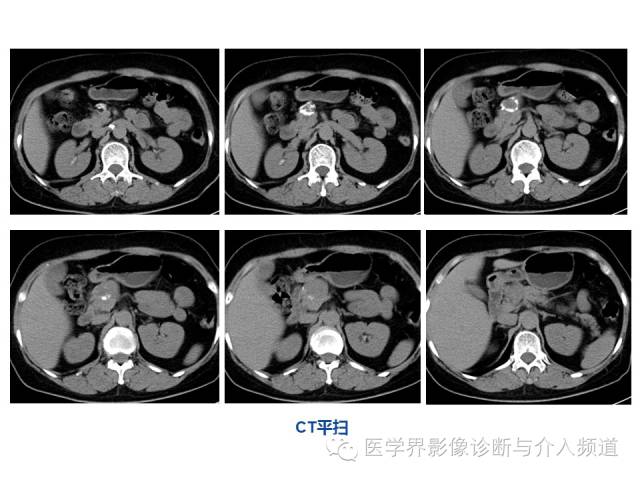 【病例】胰腺实性假乳头肿瘤1例CT及MR影像表现 【病例】胰腺实性假乳头肿瘤1例CT及MR影像表现