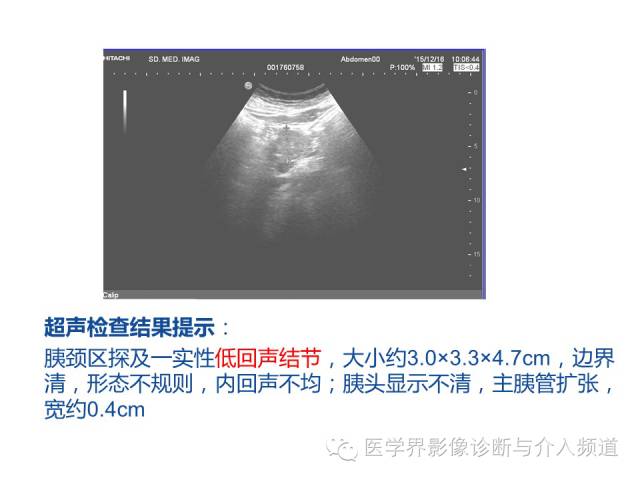 【病例】胰腺实性假乳头肿瘤1例CT及MR影像表现