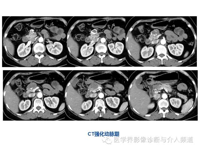 【病例】胰腺实性假乳头肿瘤1例CT及MR影像表现 【病例】胰腺实性假乳头肿瘤1例CT及MR影像表现
