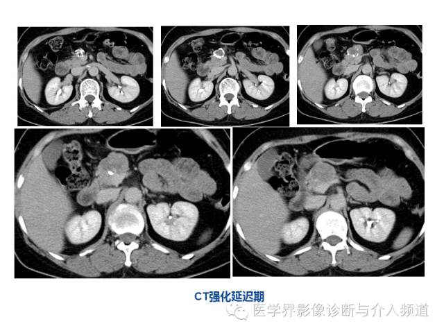 【病例】胰腺实性假乳头肿瘤1例CT及MR影像表现 【病例】胰腺实性假乳头肿瘤1例CT及MR影像表现