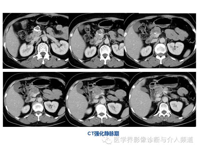 【病例】胰腺实性假乳头肿瘤1例CT及MR影像表现 【病例】胰腺实性假乳头肿瘤1例CT及MR影像表现