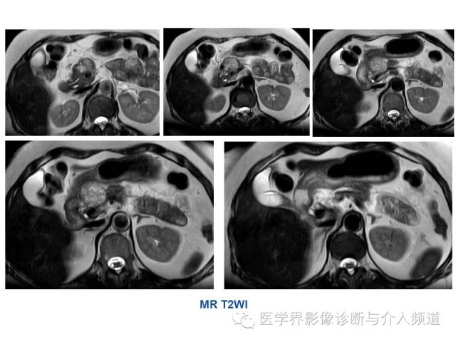 【病例】胰腺实性假乳头肿瘤1例CT及MR影像表现 【病例】胰腺实性假乳头肿瘤1例CT及MR影像表现
