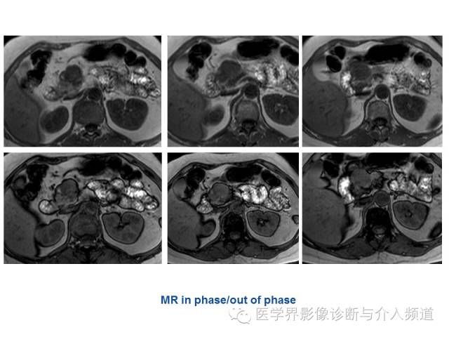【病例】胰腺实性假乳头肿瘤1例CT及MR影像表现 【病例】胰腺实性假乳头肿瘤1例CT及MR影像表现