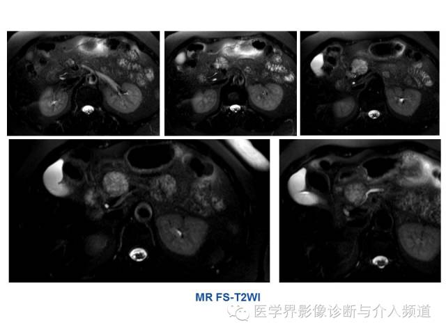 【病例】胰腺实性假乳头肿瘤1例CT及MR影像表现 【病例】胰腺实性假乳头肿瘤1例CT及MR影像表现