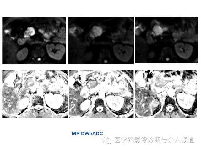 【病例】胰腺实性假乳头肿瘤1例CT及MR影像表现 【病例】胰腺实性假乳头肿瘤1例CT及MR影像表现