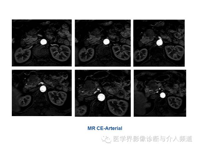 【病例】胰腺实性假乳头肿瘤1例CT及MR影像表现 【病例】胰腺实性假乳头肿瘤1例CT及MR影像表现