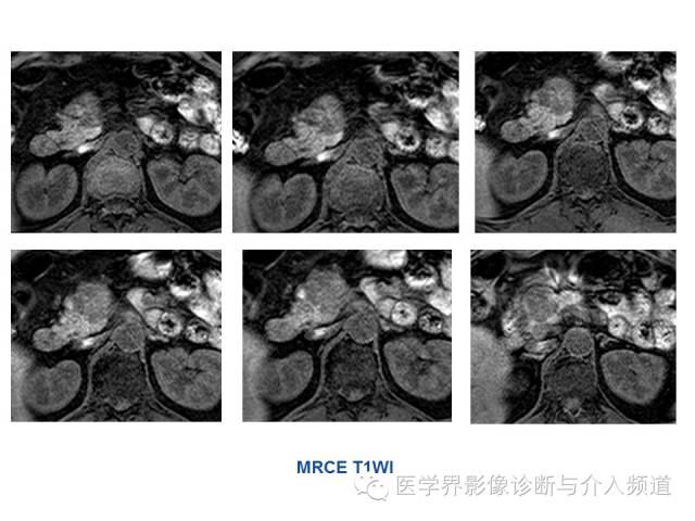 【病例】胰腺实性假乳头肿瘤1例CT及MR影像表现 【病例】胰腺实性假乳头肿瘤1例CT及MR影像表现