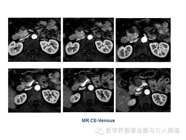【病例】胰腺实性假乳头肿瘤1例CT及MR影像表现 【病例】胰腺实性假乳头肿瘤1例CT及MR影像表现