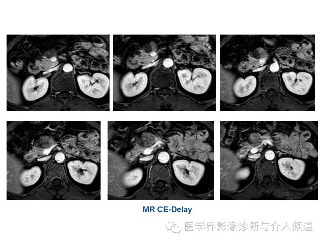 【病例】胰腺实性假乳头肿瘤1例CT及MR影像表现 【病例】胰腺实性假乳头肿瘤1例CT及MR影像表现