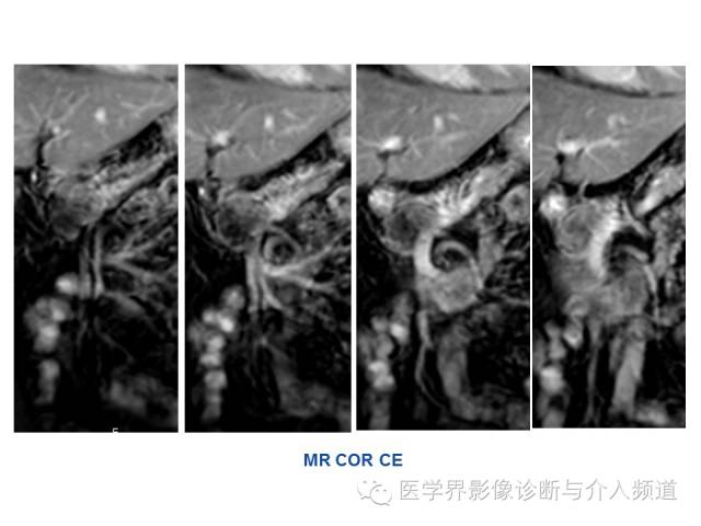 【病例】胰腺实性假乳头肿瘤1例CT及MR影像表现 【病例】胰腺实性假乳头肿瘤1例CT及MR影像表现