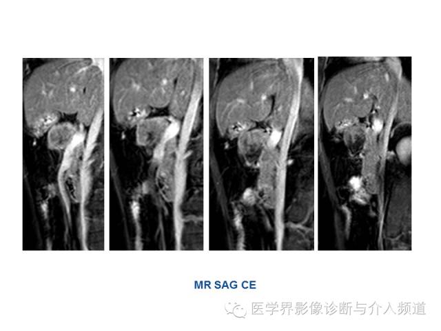 【病例】胰腺实性假乳头肿瘤1例CT及MR影像表现 【病例】胰腺实性假乳头肿瘤1例CT及MR影像表现