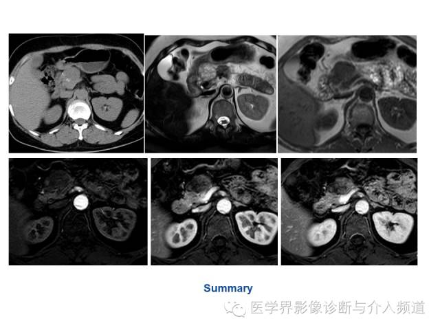 【病例】胰腺实性假乳头肿瘤1例CT及MR影像表现 【病例】胰腺实性假乳头肿瘤1例CT及MR影像表现