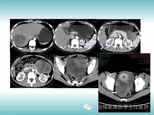 【病例】胰腺实性假乳头状肿瘤1例CT影像表现