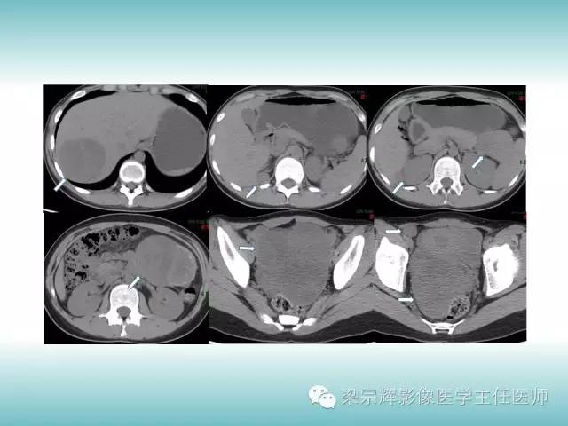 【病例】胰腺实性假乳头状肿瘤1例CT影像表现