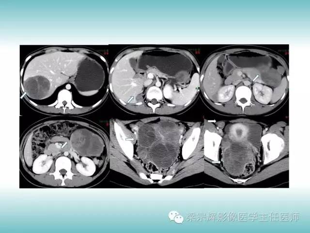 【病例】胰腺实性假乳头状肿瘤1例CT影像表现