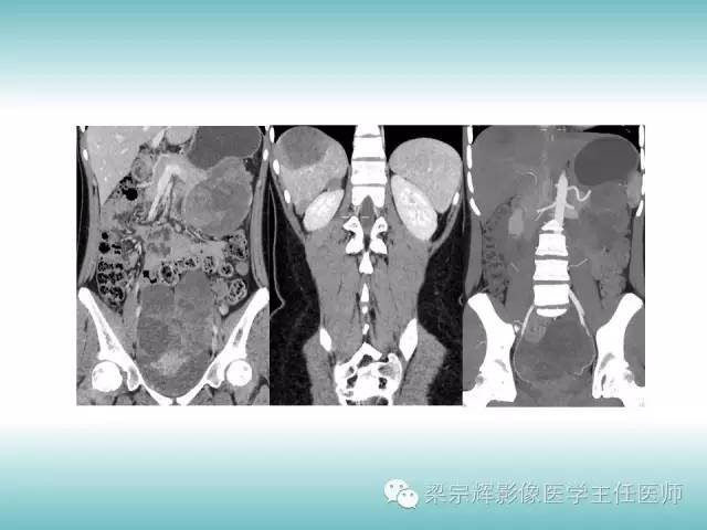 【病例】胰腺实性假乳头状肿瘤1例CT影像表现