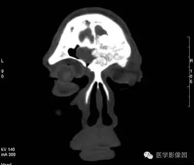 【病例】颅骨骨化性纤维瘤1例CT影像表现 【病例】颅骨骨化性纤维瘤1例CT影像表现