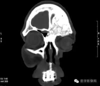 【病例】颅骨骨化性纤维瘤1例CT影像表现 【病例】颅骨骨化性纤维瘤1例CT影像表现