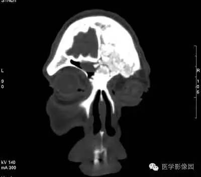 【病例】颅骨骨化性纤维瘤1例CT影像表现 【病例】颅骨骨化性纤维瘤1例CT影像表现