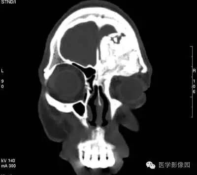 【病例】颅骨骨化性纤维瘤1例CT影像表现 【病例】颅骨骨化性纤维瘤1例CT影像表现