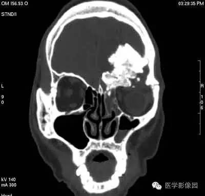 【病例】颅骨骨化性纤维瘤1例CT影像表现 【病例】颅骨骨化性纤维瘤1例CT影像表现